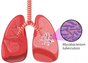 Ilustrasaun foto moras tuberculose (TBC). Foto google