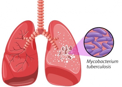 Ilustrasaun foto moras tuberculose (TBC). Foto google